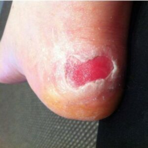 What Causes Foot Ulcers, Calluses And Blisters?