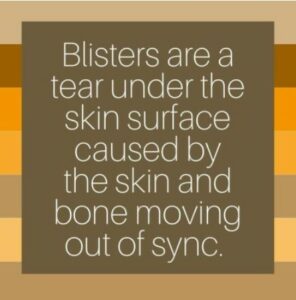 What Causes Blisters new blister paradigm