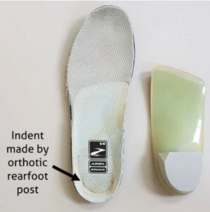 Orthotics Causing Posterior Heel Edge Blisters: Lesson #5 From Adelaide 2019