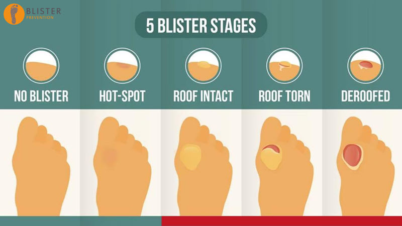 5 blister stages - blister-free; hotspot, intact roof, torn roof, defoofed