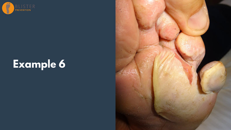 Should blisters be lanced deroofed or left intact