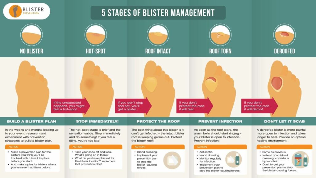 The 5 stages of blister management