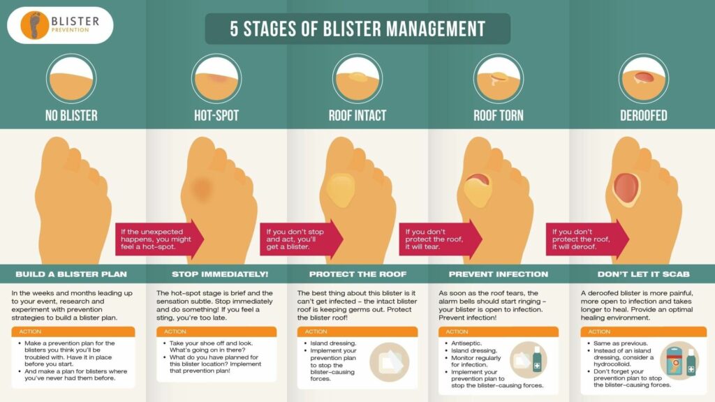 The Blister Triangle: Preventing and Treating Blisters at Home and in the  Field - WillowHavenOutdoor Survival Skills