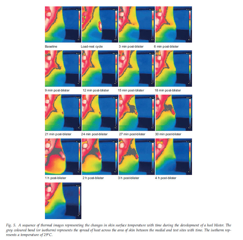 digital infrared thermographic imaging of the posterior heel before, during, and after blister formation